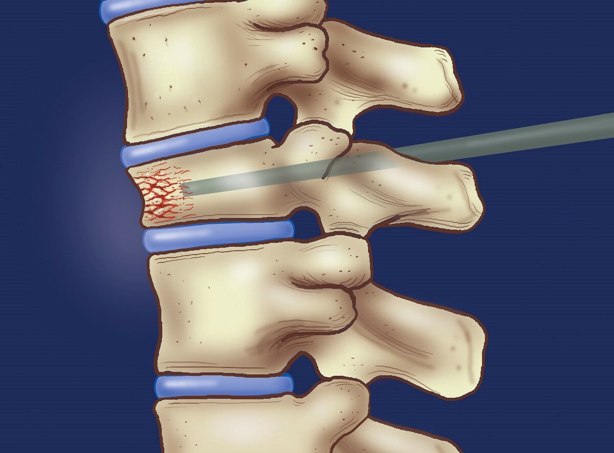 model of Vertebroplasty 